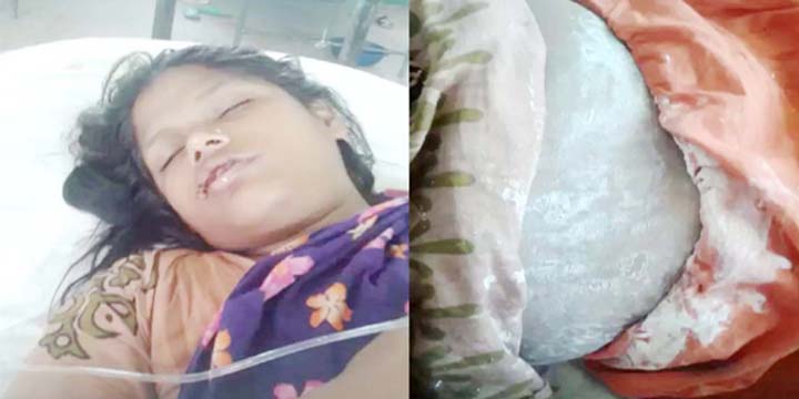 সৎমায়ের দেয়া আগুনে মৃত্যুর মুখে মিনোয়ারা