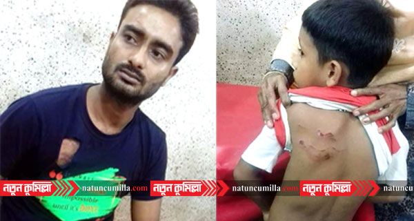 কুমিল্লায় কুকুরের কামড়ে শিশুসহ আহত ২৪